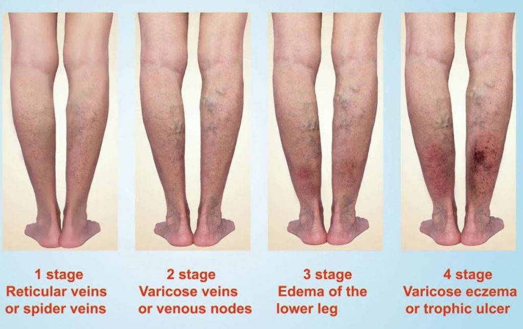 Veins Are Damaged Move and be healthy